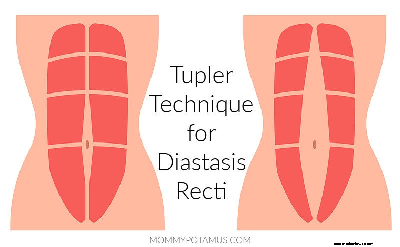 Tupler Technique for Diastasis Recti: A Personal Recovery Story