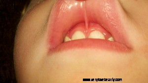 Understanding Lip Ties: Causes, Symptoms & Treatment