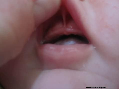 Understanding Lip Ties: Causes, Symptoms & Treatment