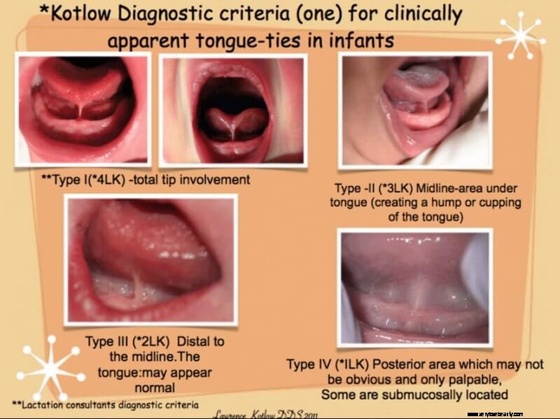 Tongue and Lip Tie Assessment: A Comprehensive Guide for Parents