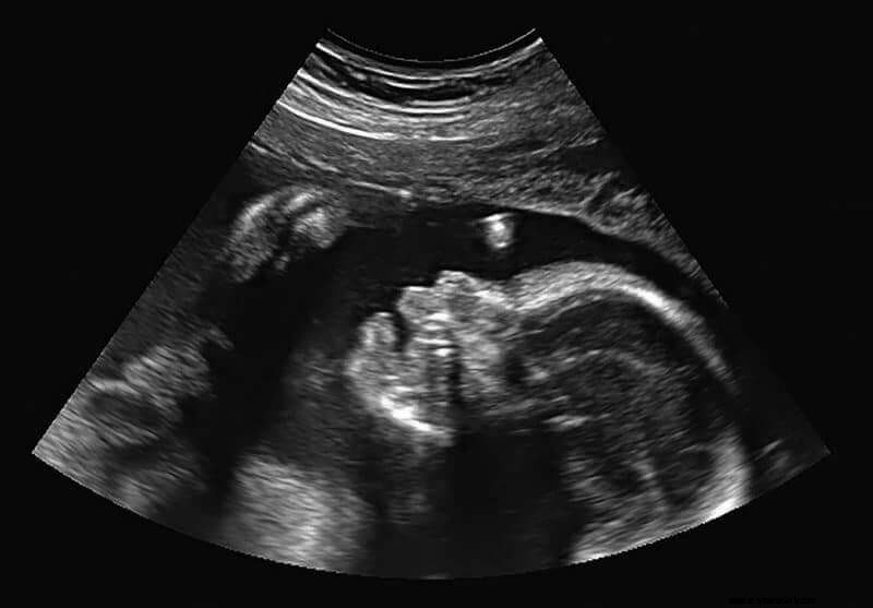 Prenatal Ultrasound: Benefits, Risks, and What to Expect