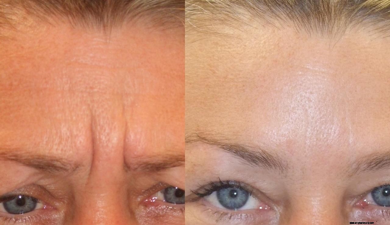 Botox Explained: How It Works, Risks & Benefits - A Balanced Overview