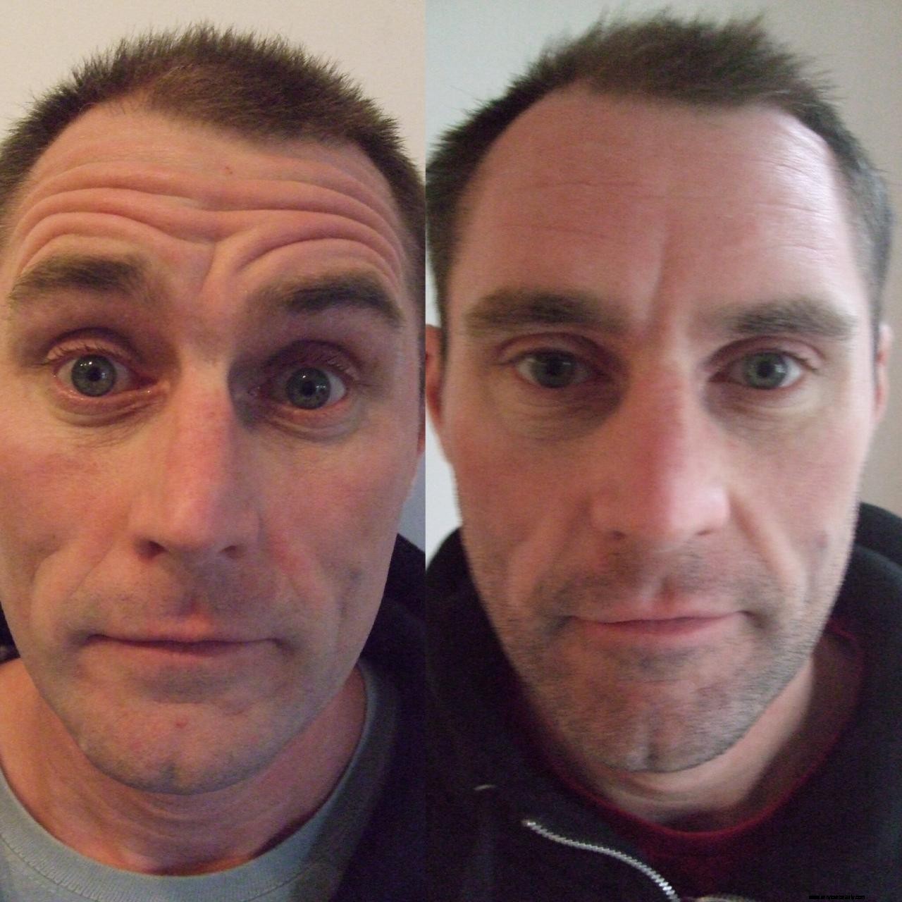 Botox Explained: How It Works, Risks & Benefits - A Balanced Overview