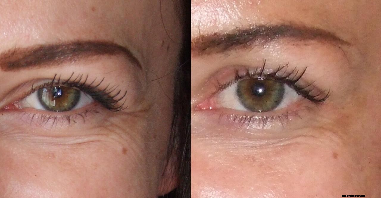 Botox Explained: How It Works, Risks & Benefits - A Balanced Overview