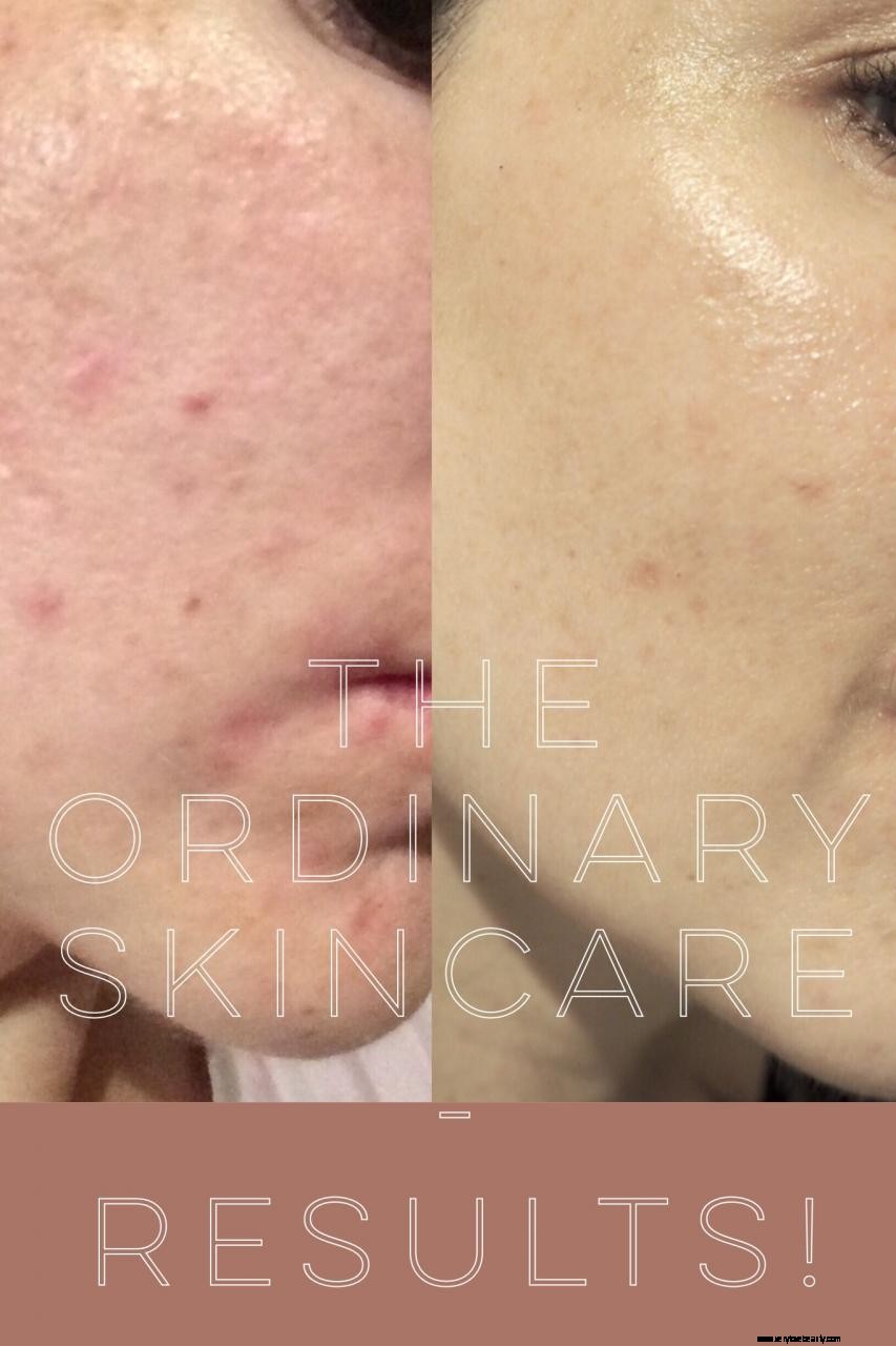 The Ordinary Skincare Results: 5-Week Update & Before/After Photos