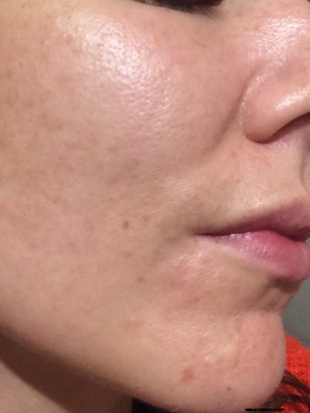 The Ordinary Skincare Results: 5-Week Update & Before/After Photos