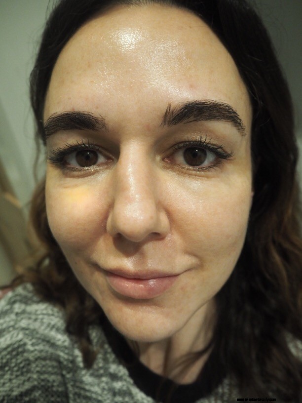 The Ordinary Skincare Results: 5-Week Update & Before/After Photos