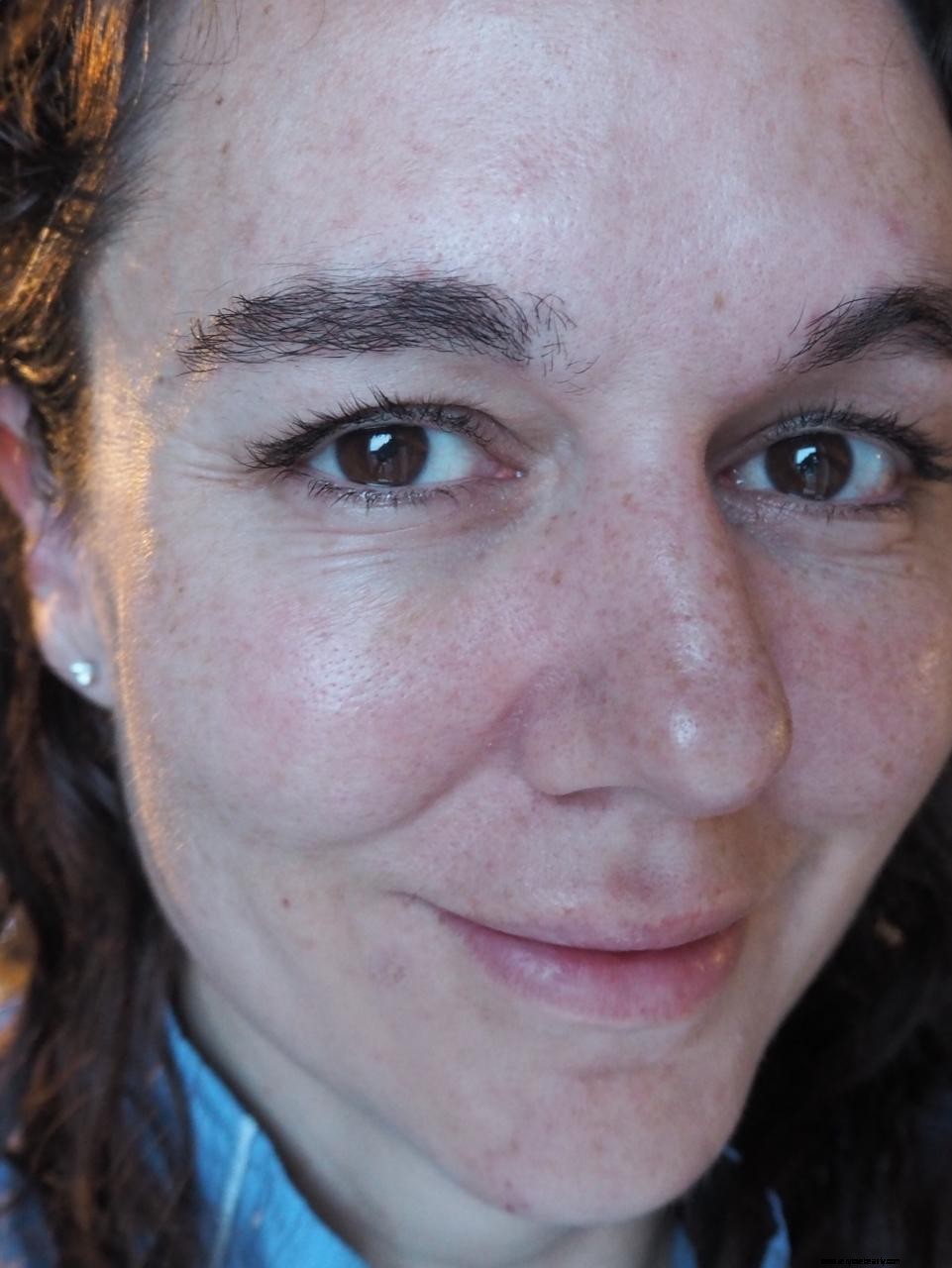 Acne, Aging & Pigmentation Skincare: A Personal Journey