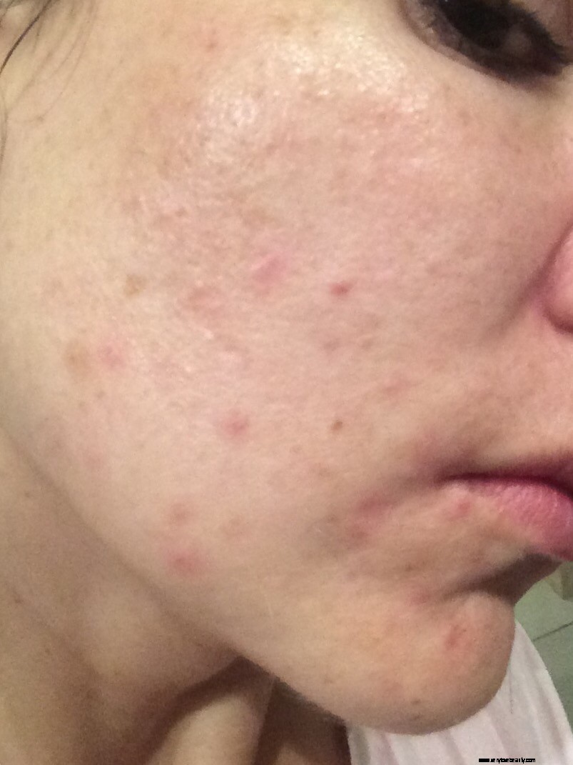 Acne, Aging & Pigmentation Skincare: A Personal Journey