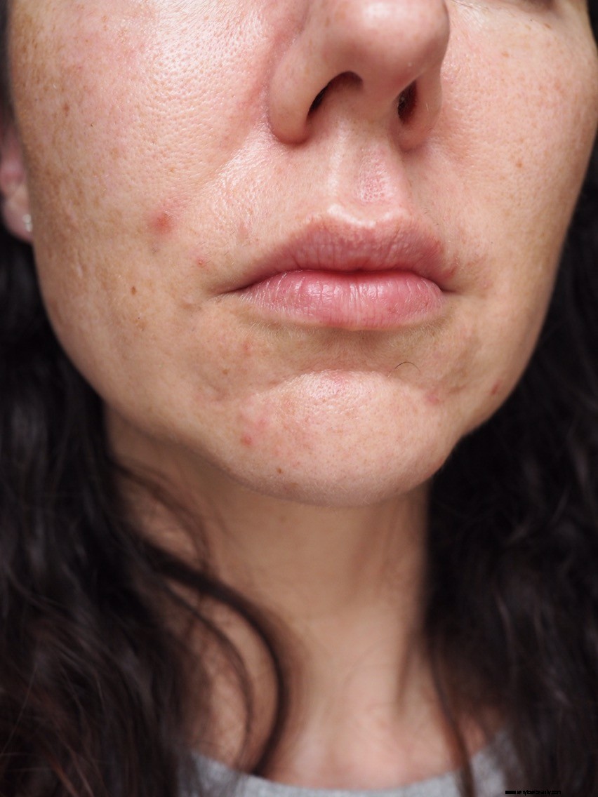Acne, Aging & Pigmentation Skincare: A Personal Journey