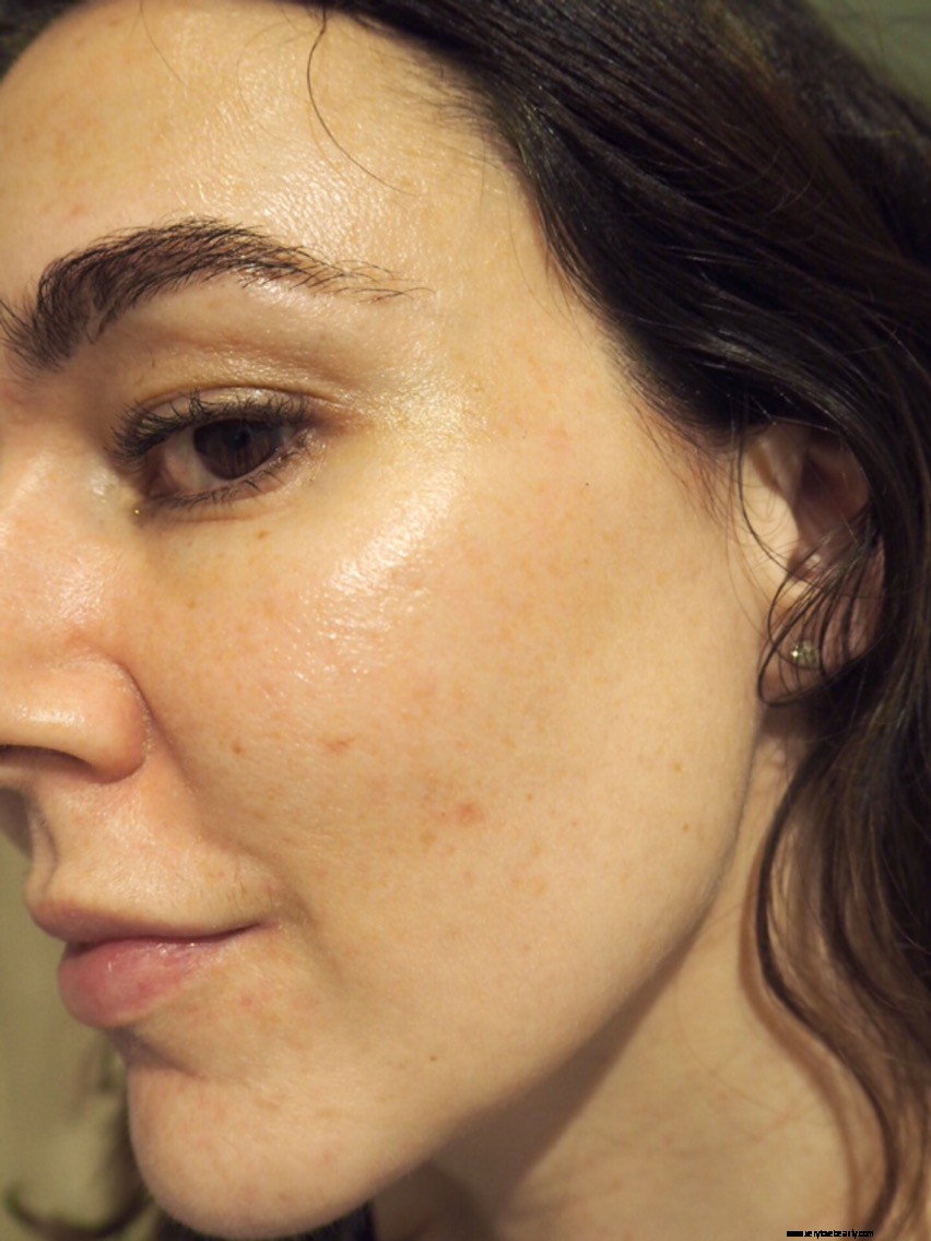 Acne, Aging & Pigmentation Skincare: A Personal Journey
