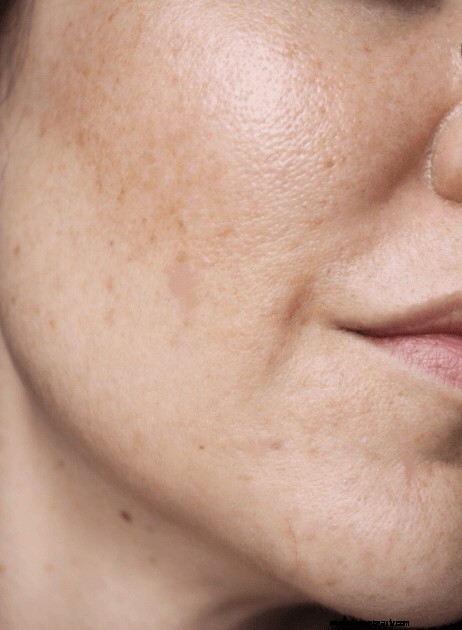 Acne, Aging & Pigmentation Skincare: A Personal Journey