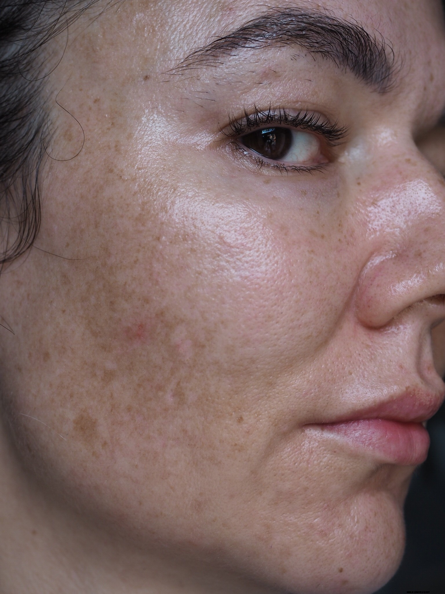 The Ordinary for Melasma & Hyperpigmentation: A Skincare Guide