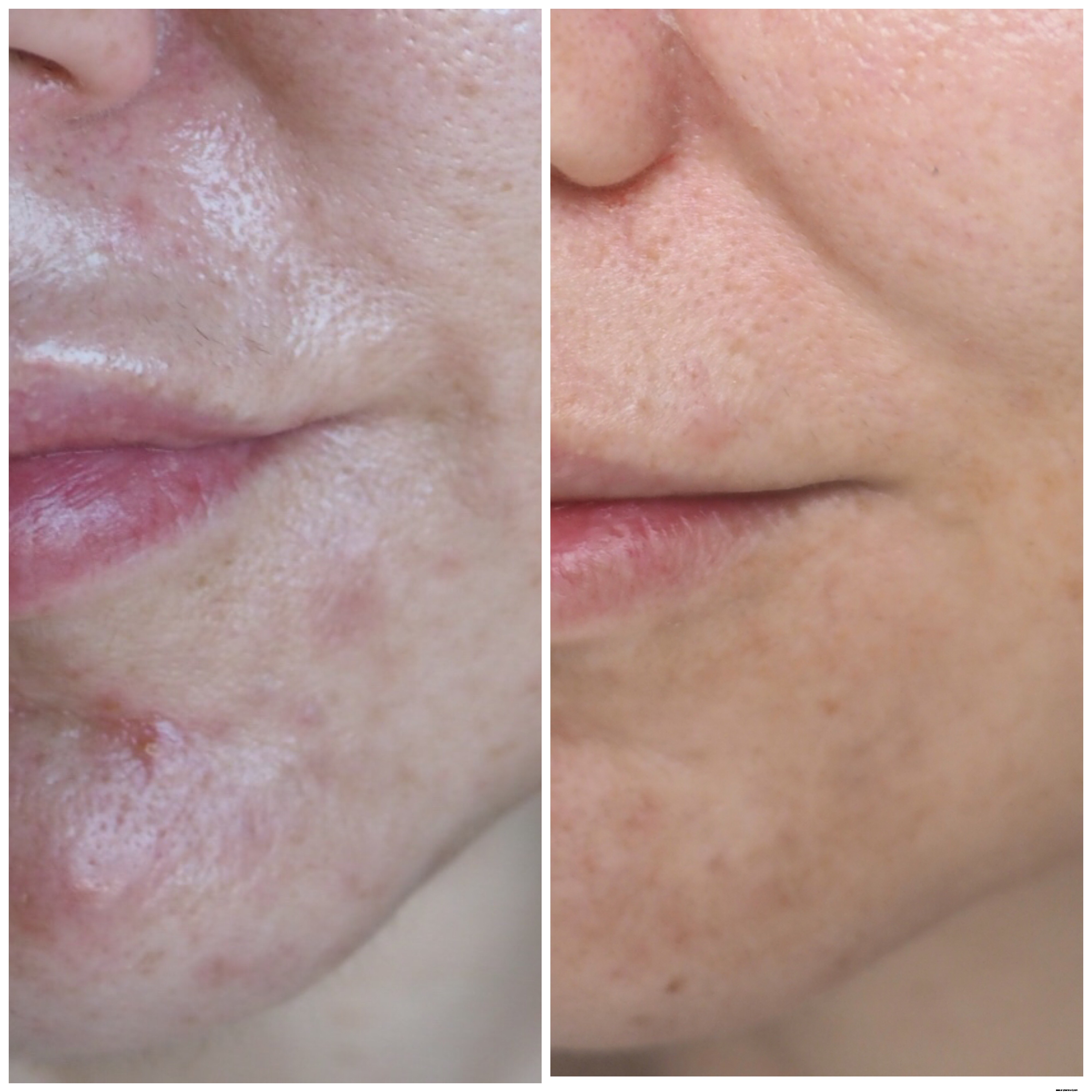 Tretinoin & The Ordinary: A Guide to Retinoid Skincare