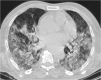 COVID-19 Chest CT: Protocols & Radiation Dose Management - A Review