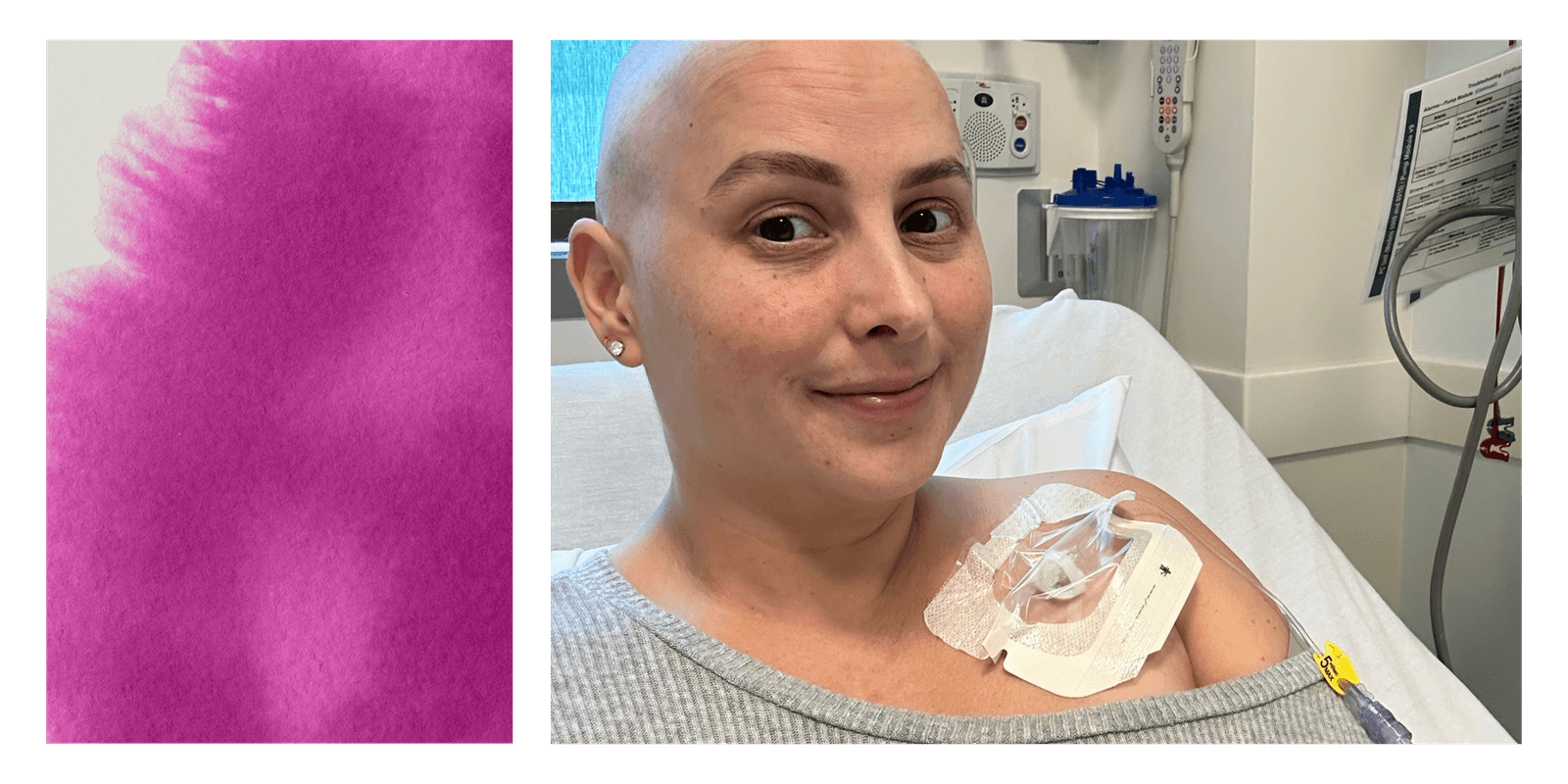 Rising Breast Cancer Rates in Pregnancy & Postpartum Women: Causes, Risks, and Early Detection