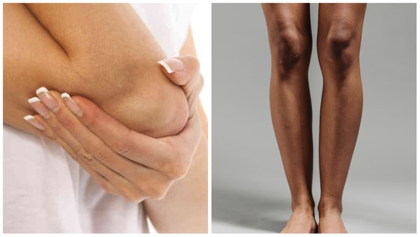 6 Proven DIY Remedies to Lighten Dark Elbows and Knees