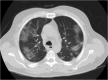 CT thoracique COVID-19 :protocoles et gestion des doses de rayonnement - Une revue 
